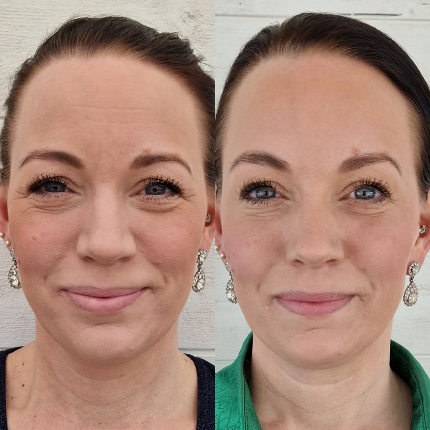 Före och efter botox upper face